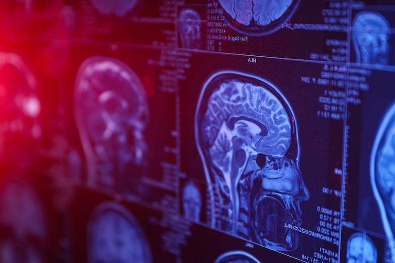 MRI scan of the head and brain